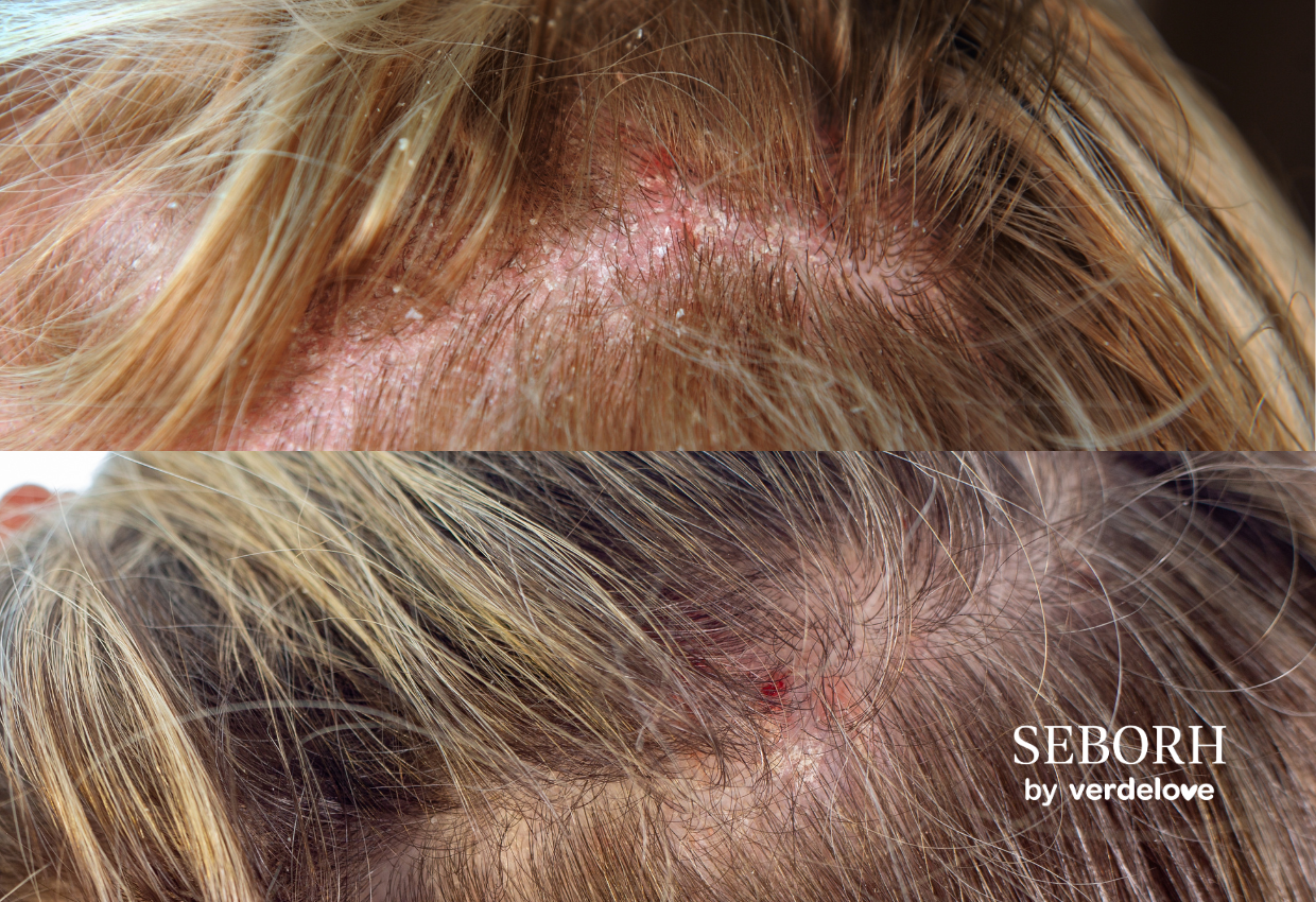 Zdjęcie pokazujące jak wygląda łojotokowe zapalenie skóry głowy
