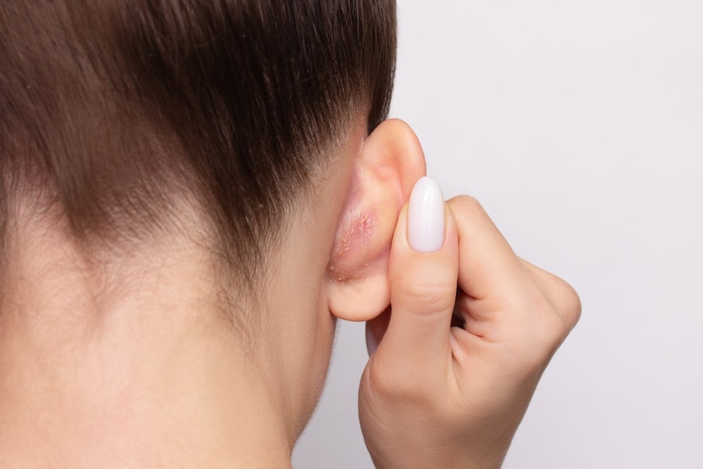 Łojotokowe zapalenie skóry za uchem