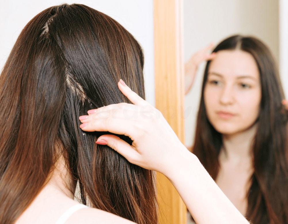 Domowe sposoby na łojotokowe zapalenie skóry