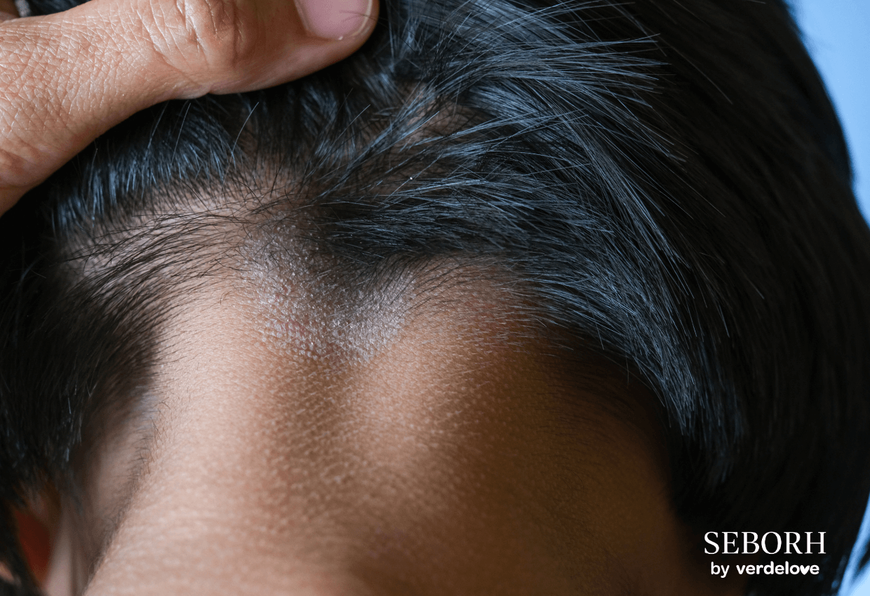 Czego unikać przy łojotokowym zapaleniu skóry?