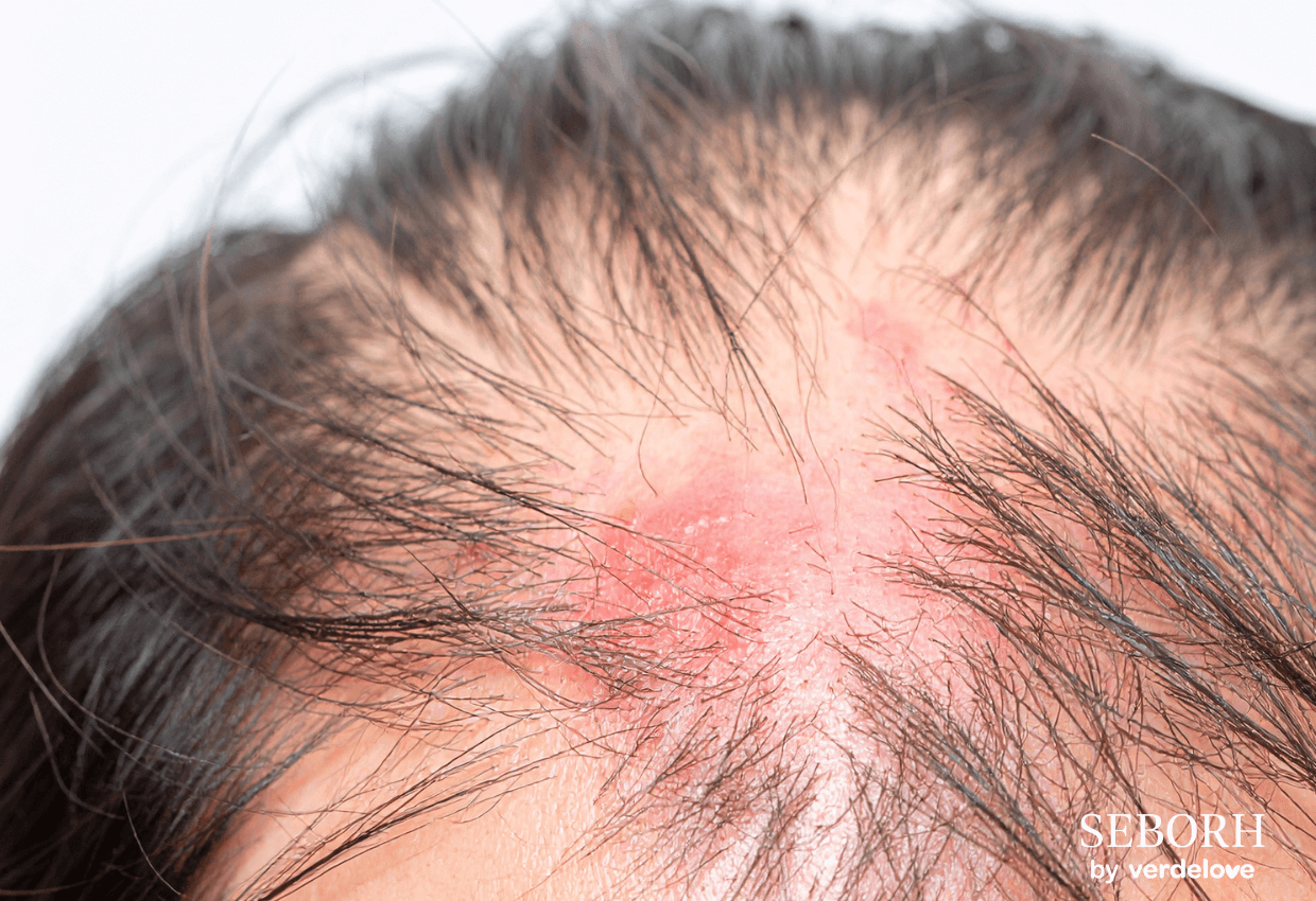 Jak dbać o skórę twarzy przy łojotokowym zapaleniu skóry?