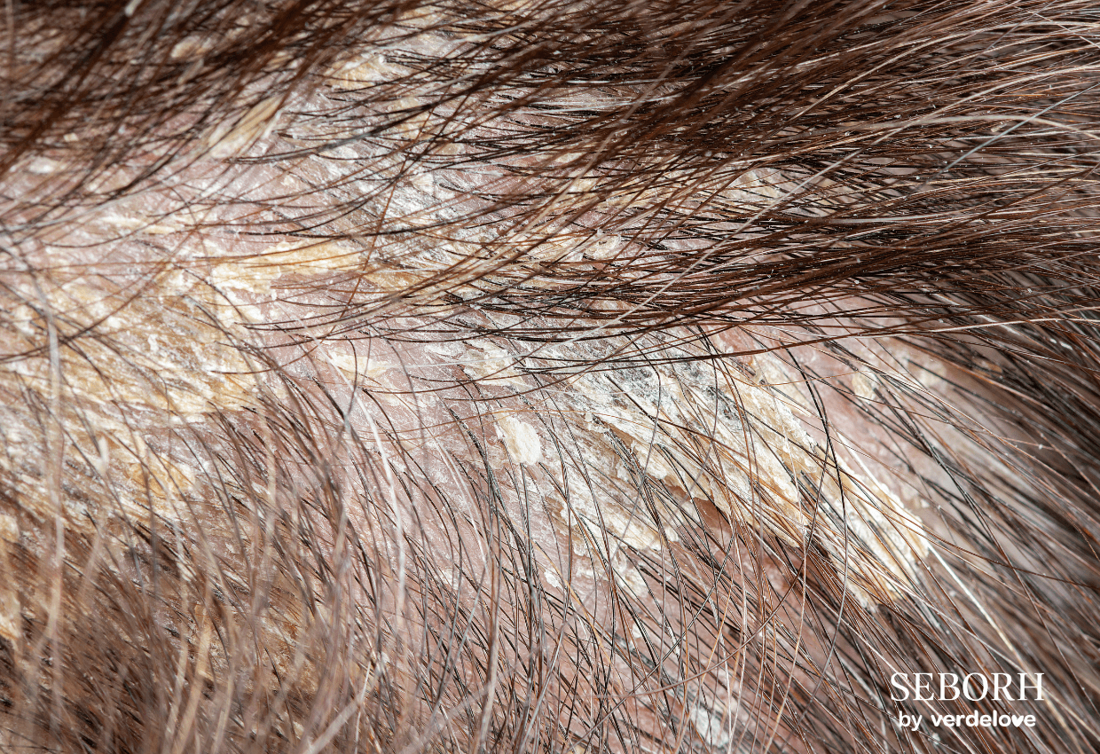 Łojotokowe zapalenie skóry na głowie