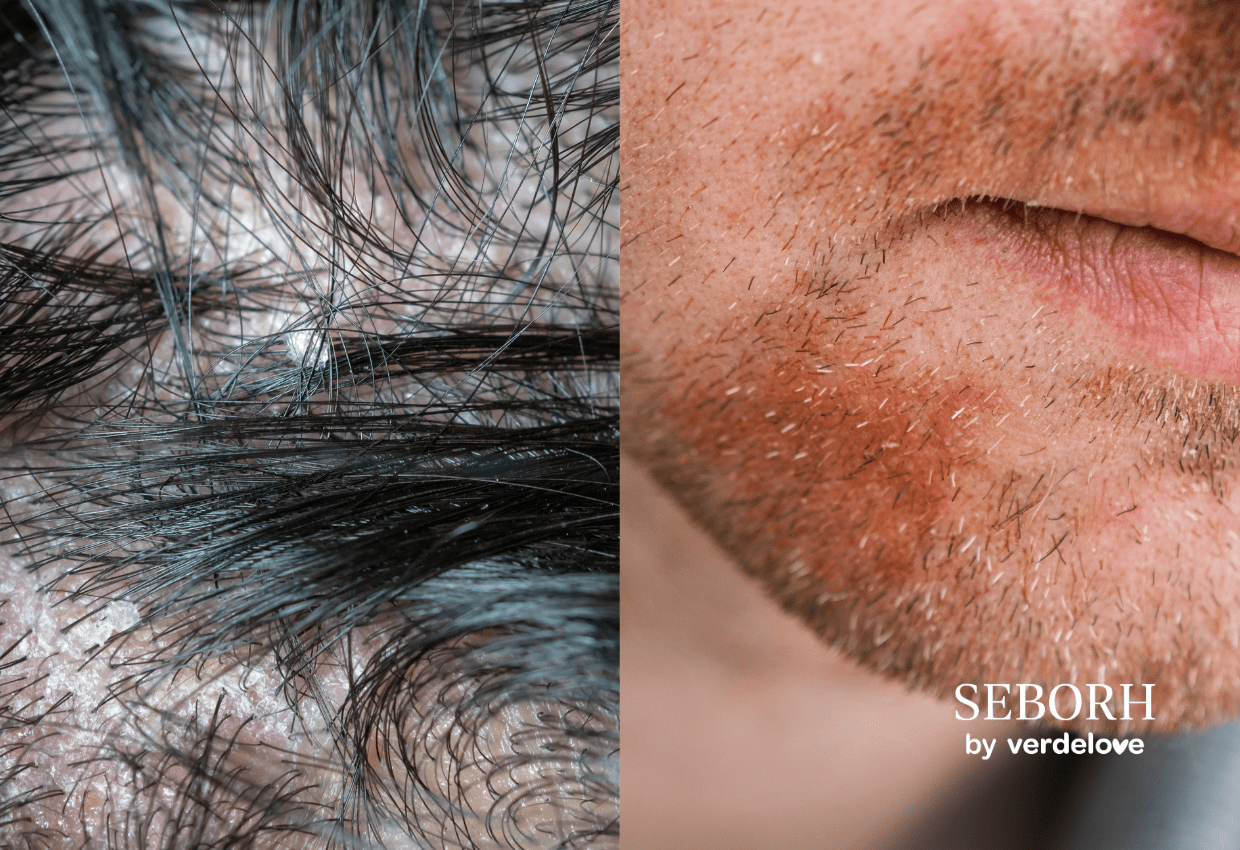 Jakie są objawy łojotokowego zapalenia skóry?