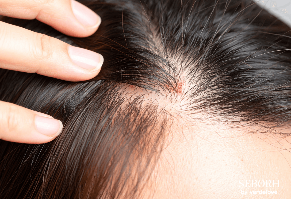 Skuteczne szampony na łojotokowe zapalenie skóry – które warto kupić?