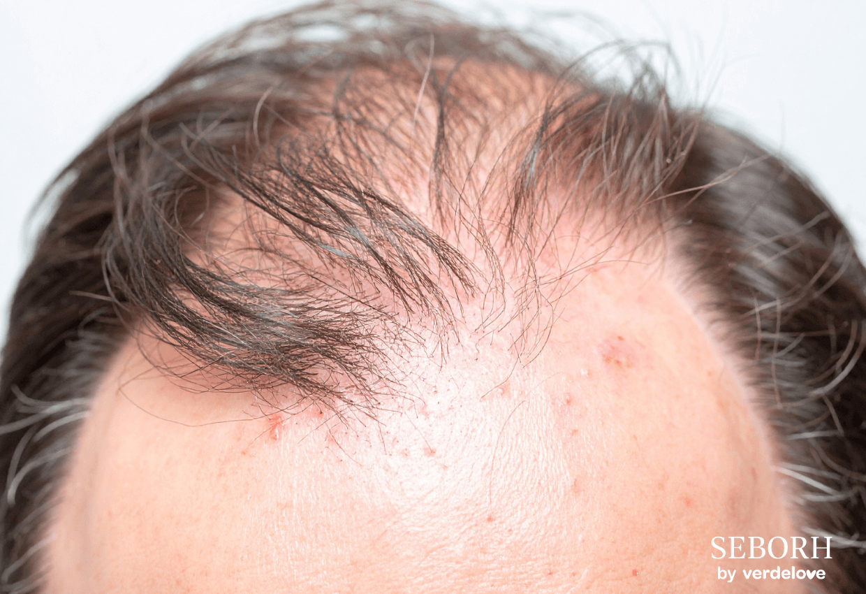 łysienie łojotokowe