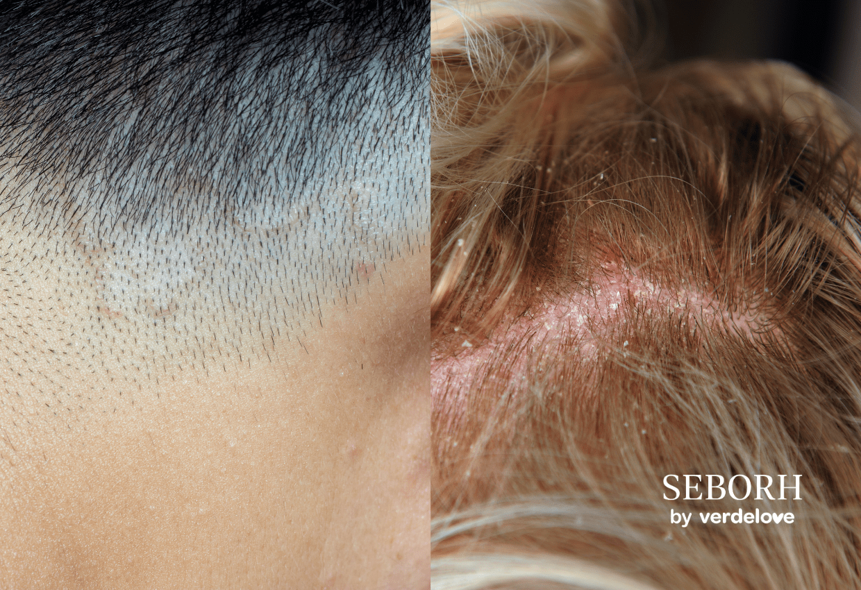 Atopowe i łojotokowe zapalenie skóry głowy – jak odróżnić te schorzenia?