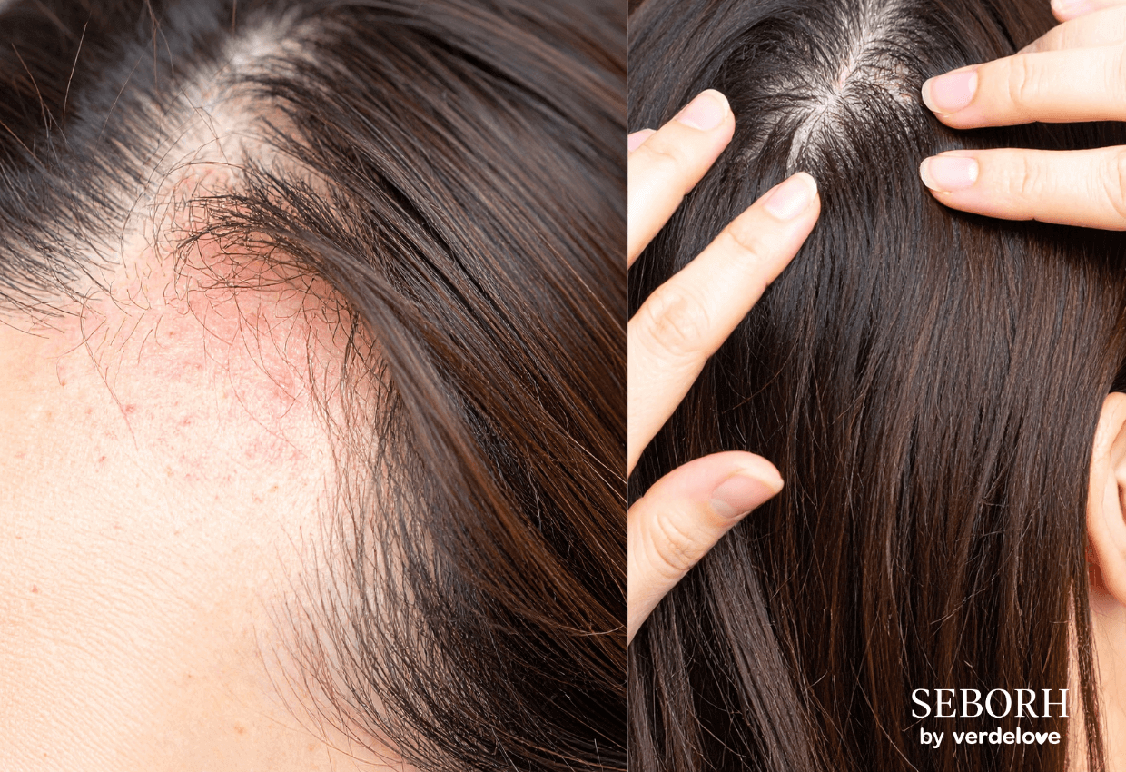 Atopowe i łojotokowe zapalenie skóry głowy – jak odróżnić te schorzenia?