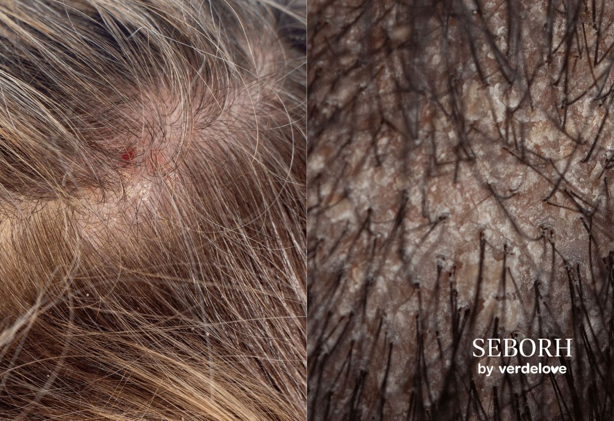 Atopowe i łojotokowe zapalenie skóry głowy – jak odróżnić te schorzenia?